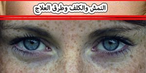 النمش والكلف وطرق العلاج